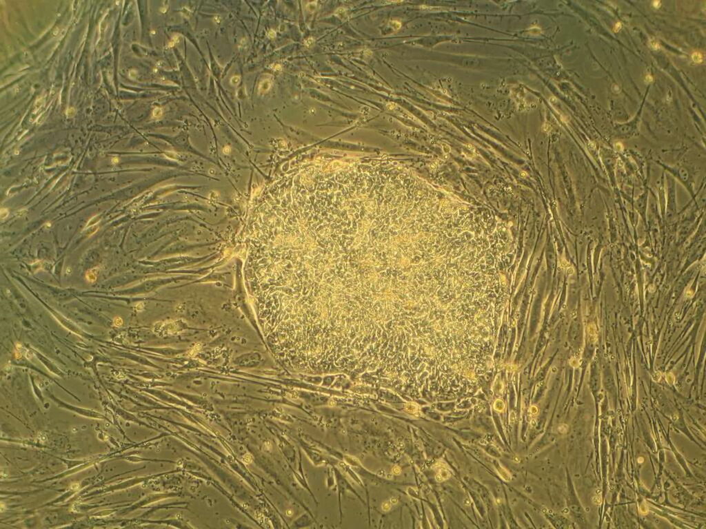 Pluripotent Stem Cells Enhance Partial Motor Recovery in Patients with Spinal Cord Injury